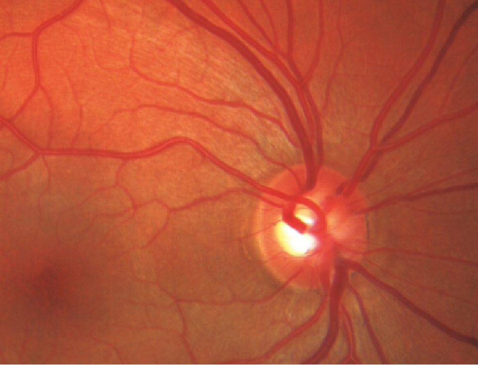 Glaucoma Factors img